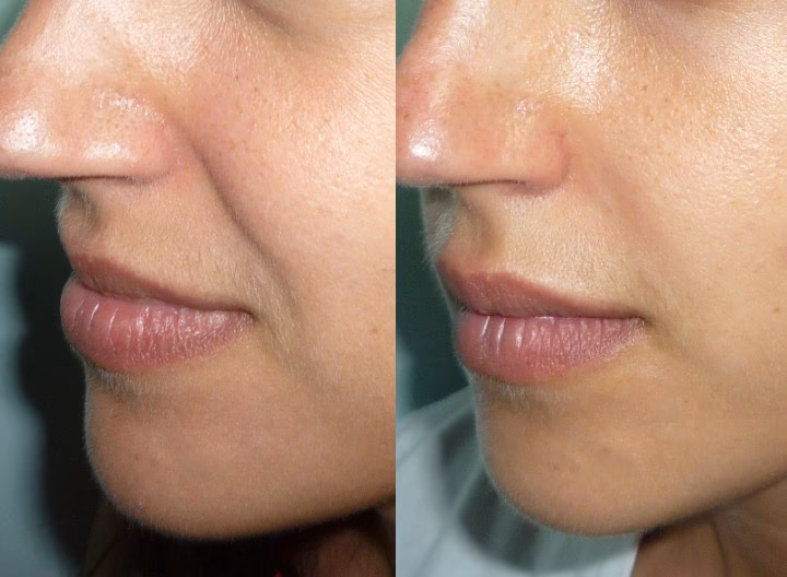 Pourquoi ne pas injecter les sillons nasogéniens ?